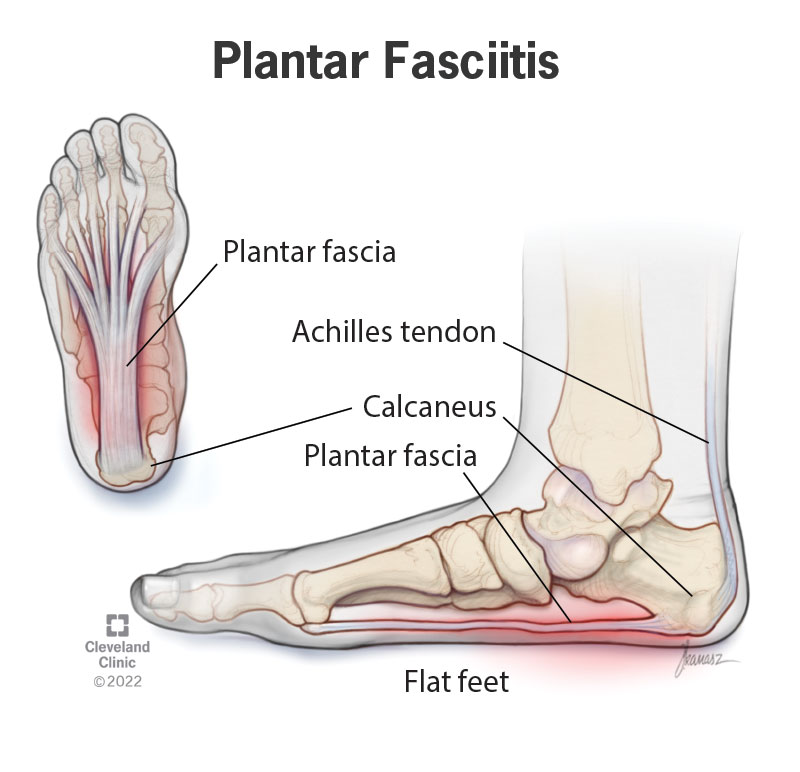 Plantar Fasciitis Treatment